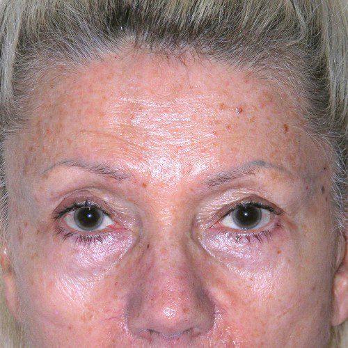 Blepharoplasty 10 Before Photo 