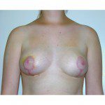 Breast Asymmetry  2 After Photo - 8