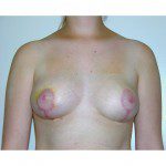 Breast Asymmetry  2 After Photo - 7