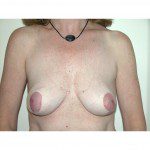 Breast Asymmetry  4 After Photo - 6