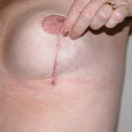 Breast Asymmetry 4 Before Photo