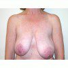 Breast Asymmetry 4 Before Photo Thumbnail