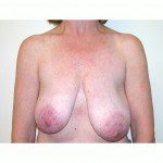 Breast Asymmetry  4 Before Photo - 6