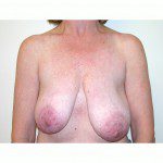 Breast Asymmetry  4 Before Photo - 5