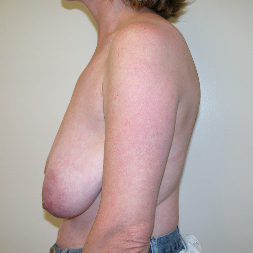 Breast Asymmetry 4 Before Photo