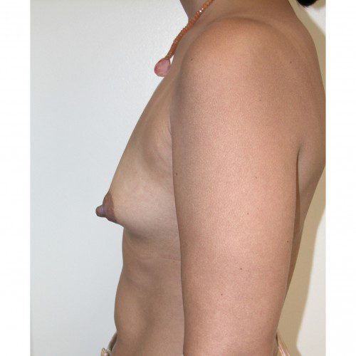 Breast Asymmetry 5 Before Photo