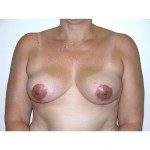 Breast Asymmetry  6 After Photo - 4