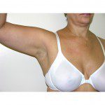 Breast Asymmetry  7 After Photo - 2