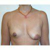 Breast Asymmetry 5 Before Photo Thumbnail