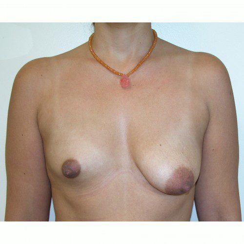 Breast Asymmetry 5 Before Photo 