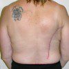 IMPLANT/LATISSIMUS RECON 2 After Photo Thumbnail