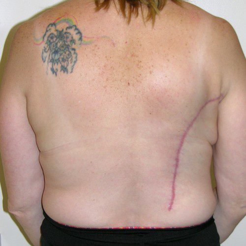 IMPLANT/LATISSIMUS RECON 2 After Photo