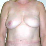 IMPLANT/LATISSIMUS RECON 2 Before Photo - 8