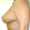 Breast Lift 10 After Photo Thumbnail
