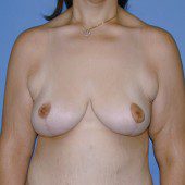 Breast Lift 12