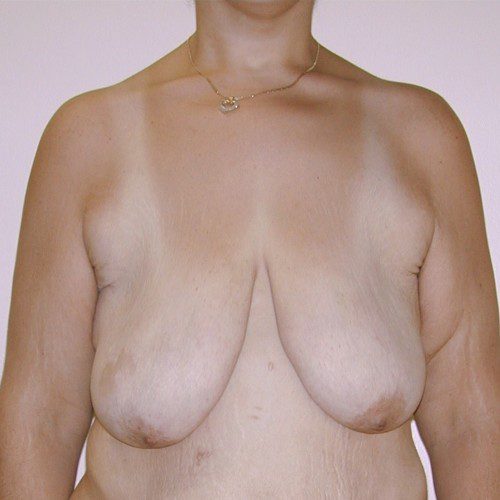 Breast Lift 12 Before Photo 