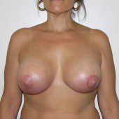 Breast Lift 14
