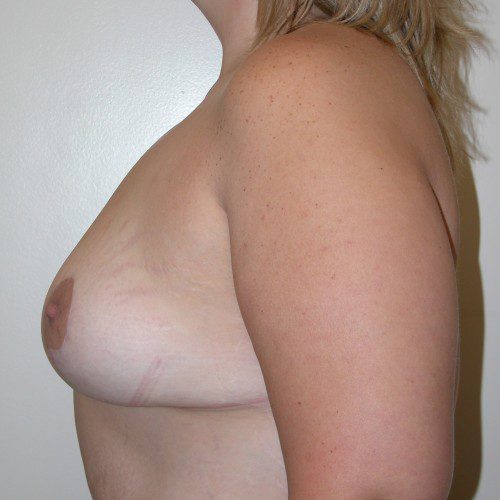 Breast Lift 15 After Photo