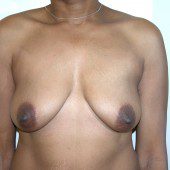 Breast Lift 16