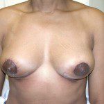 Breast Lift 16 After Photo - 1