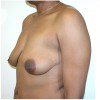 Breast Lift 16 Before Photo Thumbnail