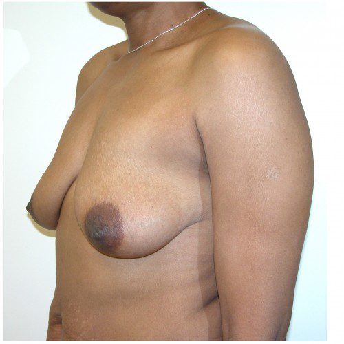 Breast Lift 16 Before Photo