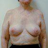 Breast Lift 05 After Photo Thumbnail