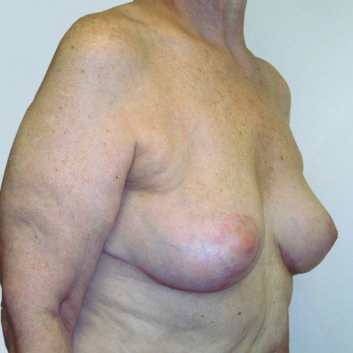 Breast Lift 05 After Photo