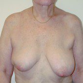 Breast Lift 05