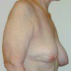 Breast Lift 05 Before Photo Thumbnail