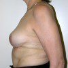 Breast Lift 03 After Photo Thumbnail