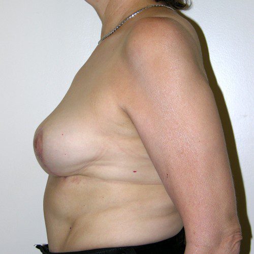 Breast Lift 03 After Photo