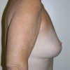 Breast Lift 06 After Photo Thumbnail