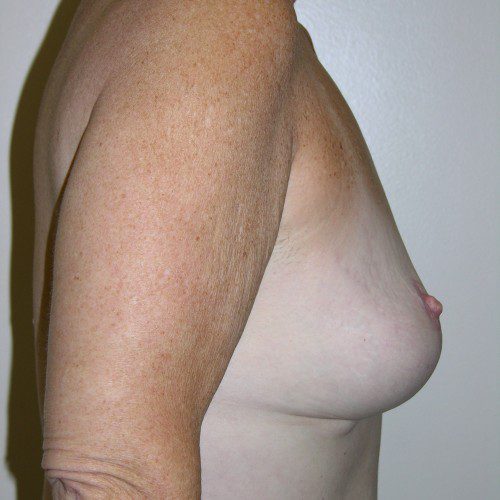 Breast Lift 06 After Photo