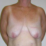 Breast Lift 06 Before Photo - 10