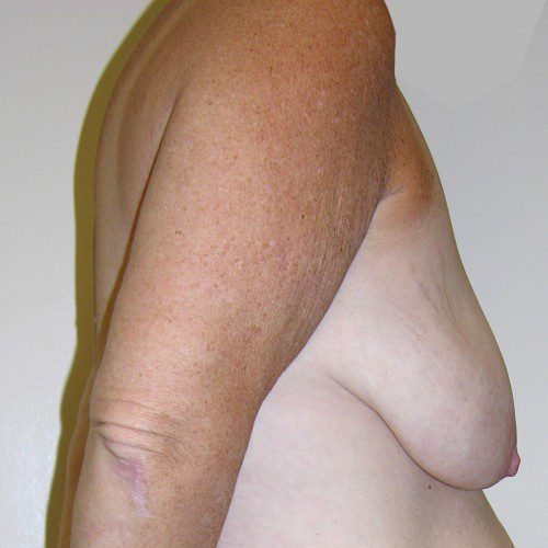 Breast Lift 06 Before Photo
