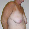 Breast Lift 06 Before Photo Thumbnail