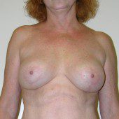 Breast Lift 07