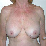 Breast Lift 07 Before Photo - 9