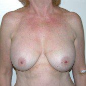 Breast Lift 07