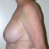 Breast Lift 07 Before Photo Thumbnail