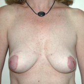 Breast Lift 08