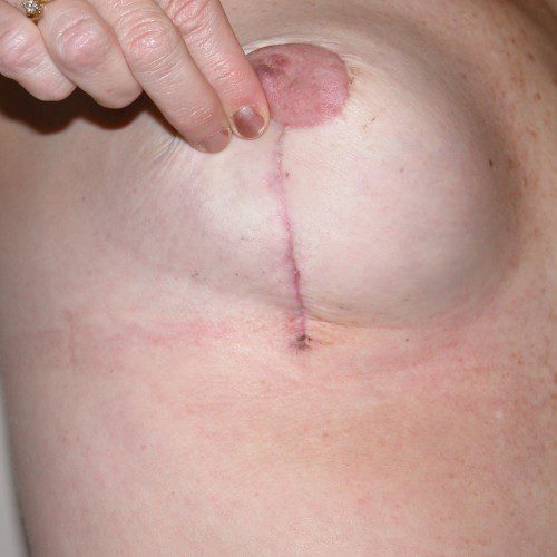 Breast Lift 08 Before Photo