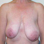 Breast Lift 08 Before Photo - 8