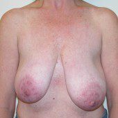 Breast Lift 08