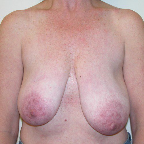 Breast Lift 08 Before Photo 