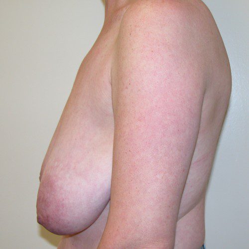 Breast Lift 08 Before Photo