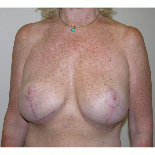 Breast Lift 09 After Photo 