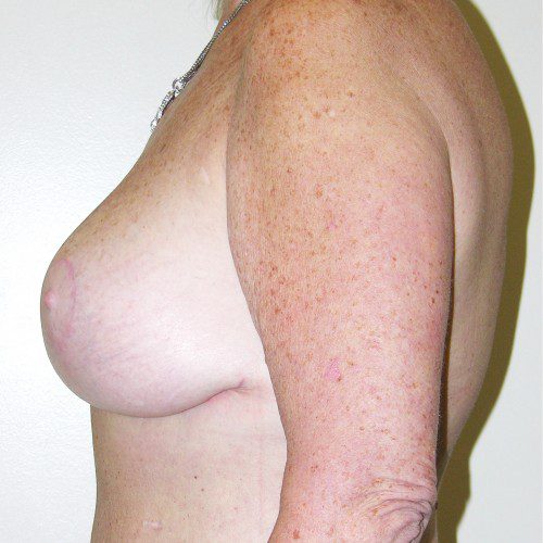 Breast Lift 09 After Photo