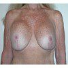 Breast Lift 09 Before Photo Thumbnail
